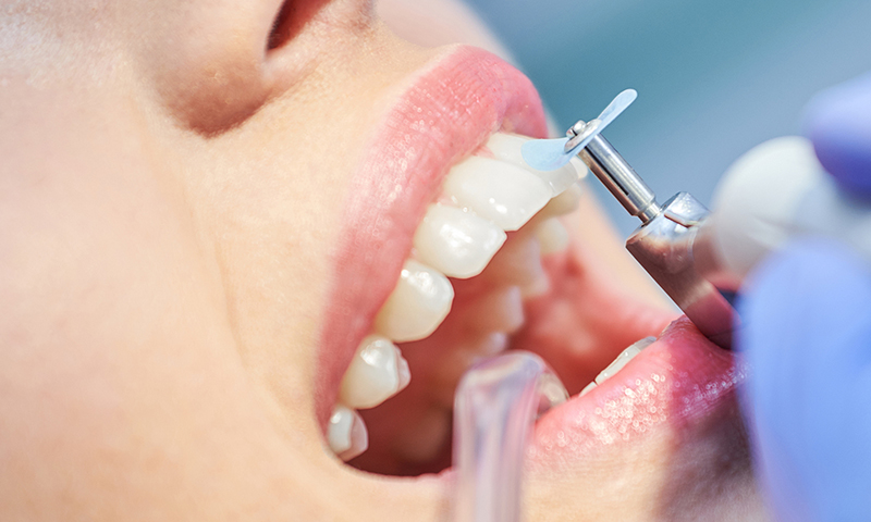 Polimento realizado durante a limpeza dentária